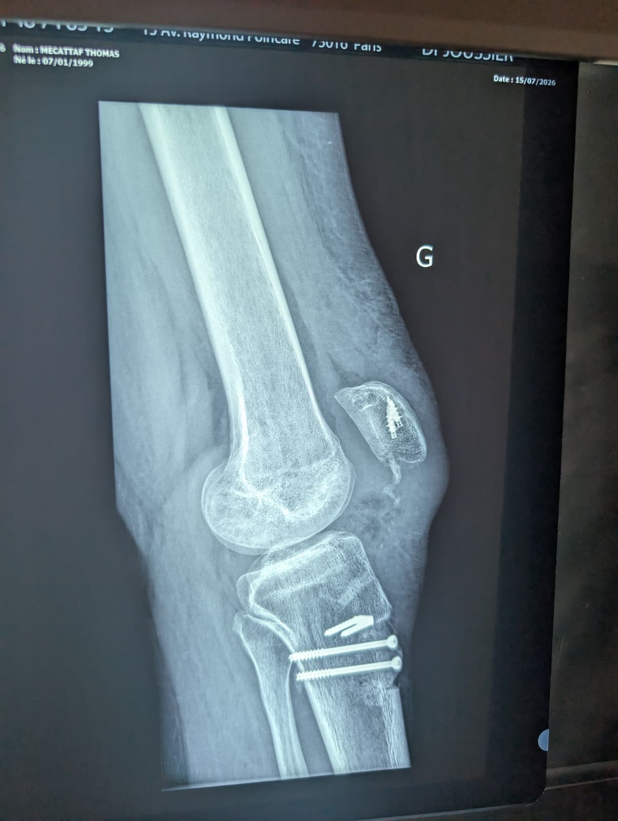 Radiographie du genou gauche, cliché de profil, 15/07/2026